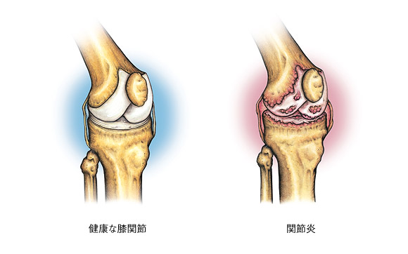 図:健康な股関節・関節炎