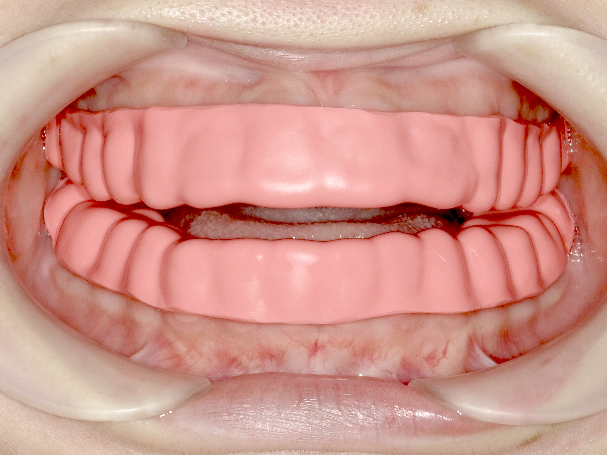 マウスピース（後）